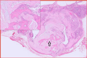 Benign mixed mammary