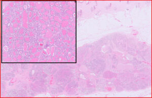 Mammary lobular hyperplasia
