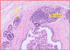 Mammary epitheliosis