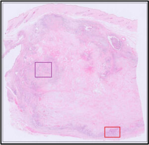 Mammary carcinosarcoma,