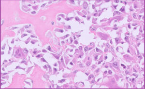 Fig 7. Higher magnification of neoplastic mesenchymal cells from Fig 6 above.
