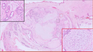 Complex mammary adenoma,