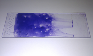 Figure 1. A very thick FNA smear