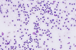 Figure 10 – Suppurative inflammation 