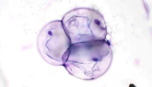 Figure 15 – Cytological features of a lipoma
