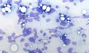 Figure 3. Excessive aspiration pressure 